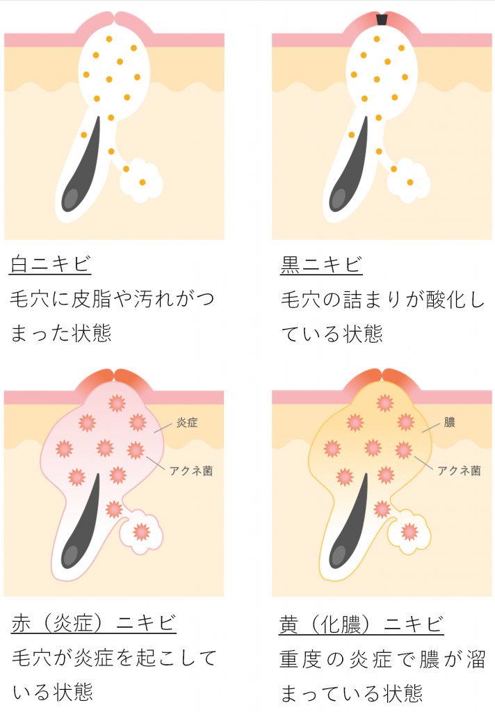 ニキビの種類